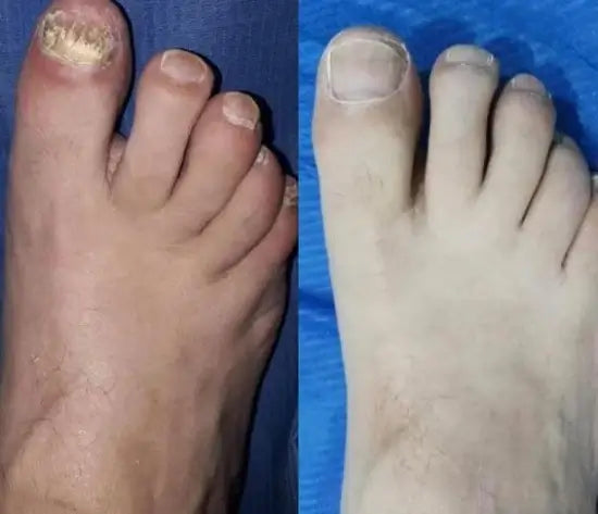 Adiós Hongos de Uñas